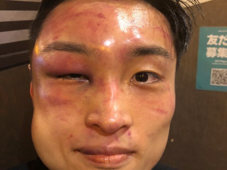 así quedó Ryosuke Nishida tras derrotar a Emmanuel Rodríguez y ser campeón mundial gallo de la FIB